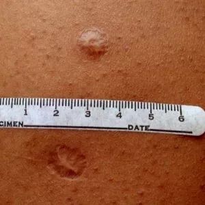A vacina que deixou uma cicatriz: por que quase todo mundo tinha uma marca no braço?