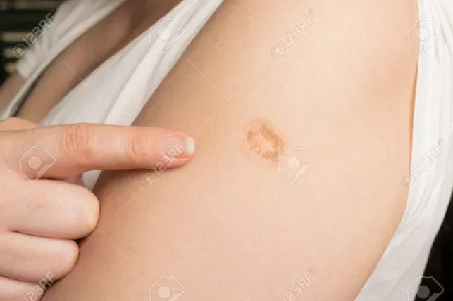 A vacina que deixou uma cicatriz: por que quase todo mundo tinha uma marca no braço?